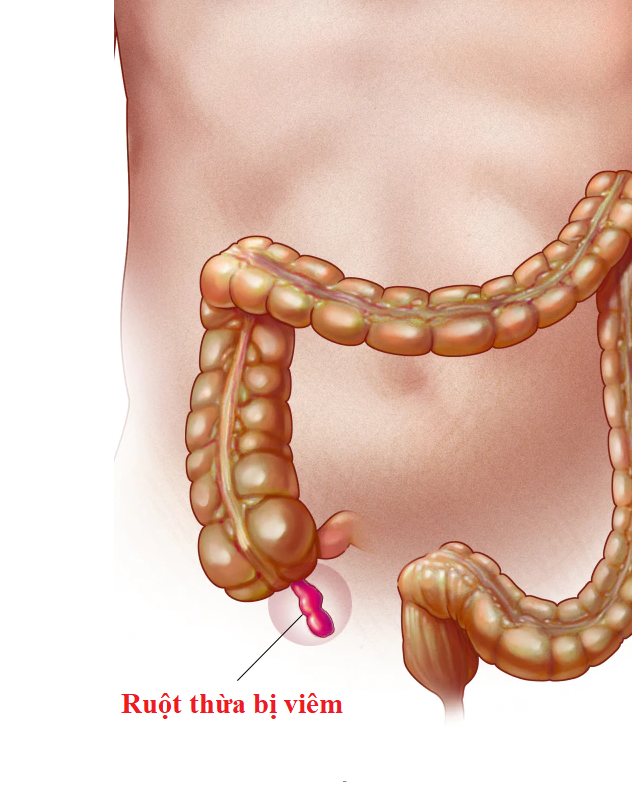 Viêm ruột thừa: triệu chứng, nguyên nhân, biến chứng và cách điều trị