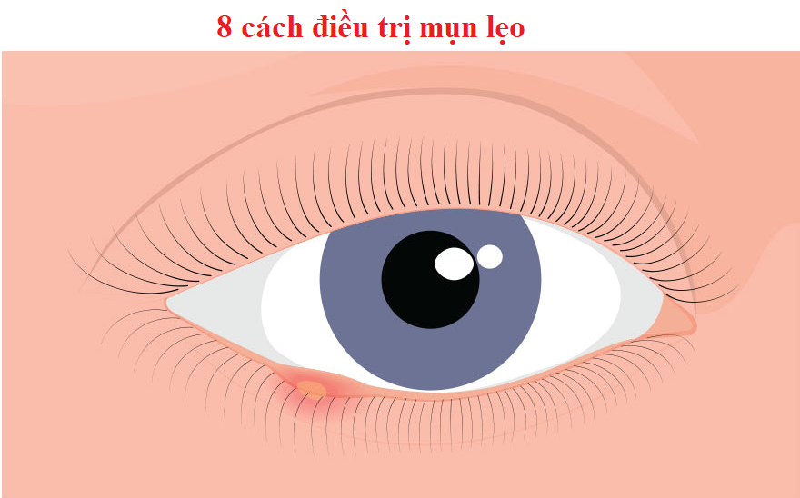 8 cách điều trị giúp nhanh khỏi mụn lẹo mắt