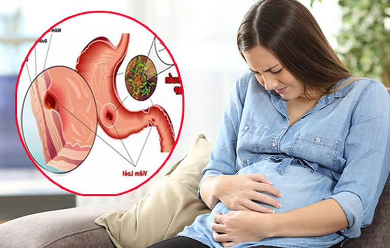 12 nguyên nhân gây đau dạ dày khi mang thai mà bạn cần biết
