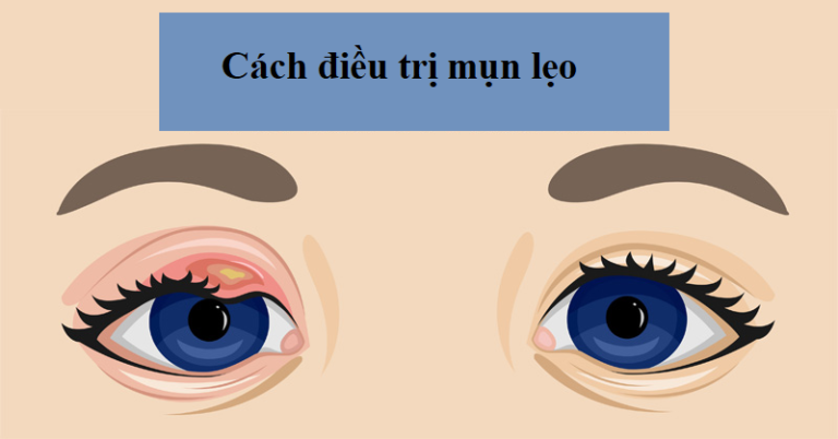 8 cách điều trị Mụn lẹo mắt nhanh nhất bạn cần biết