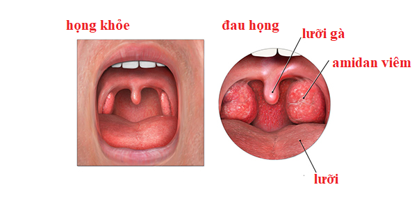 8 nguyên nhân gây đau họng dai dẳng cần biết sớm