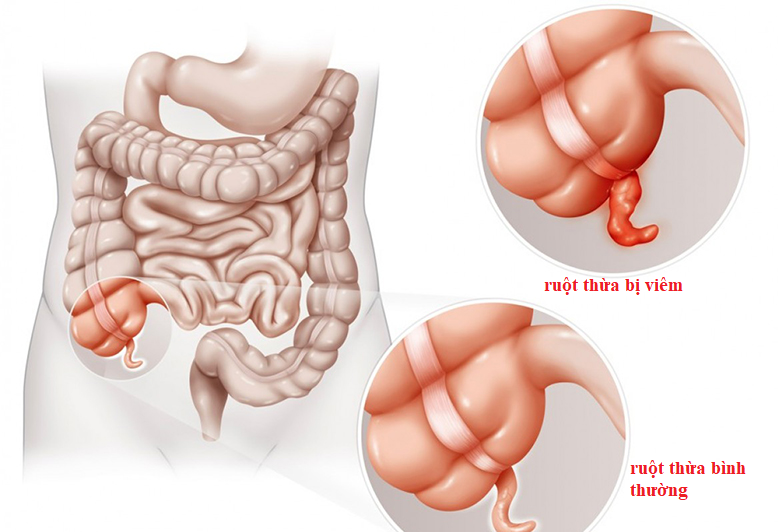 12 nguyên nhân đau bụng dưới bên phải ở nữ bạn không thể bỏ qua