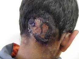 3 giai đoạn nấm da đầu giúp bạn xác định được mức độ của bệnh