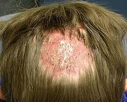 Cách phòng ngừa và điều trị bệnh nấm da đầu hiệu quả bạn cần biết