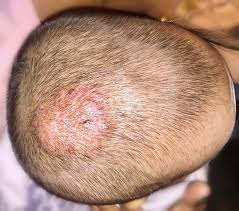 3 nguyên nhân chính gây nấm da đầu bạn nên biết