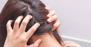 Triệu chứng điển hình của nấm da đầu bạn cần biết