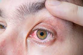 6 nguyên nhân dẫn đến đau mắt đỏ bạn nên biết