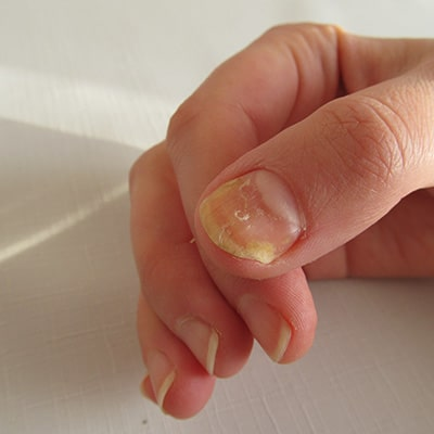 6 cách điều trị nấm móng tay hiệu quả tại nhà bạn nên biết
