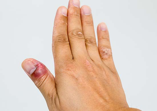 5 dấu hiệu của nấm móng tay bạn cần biết