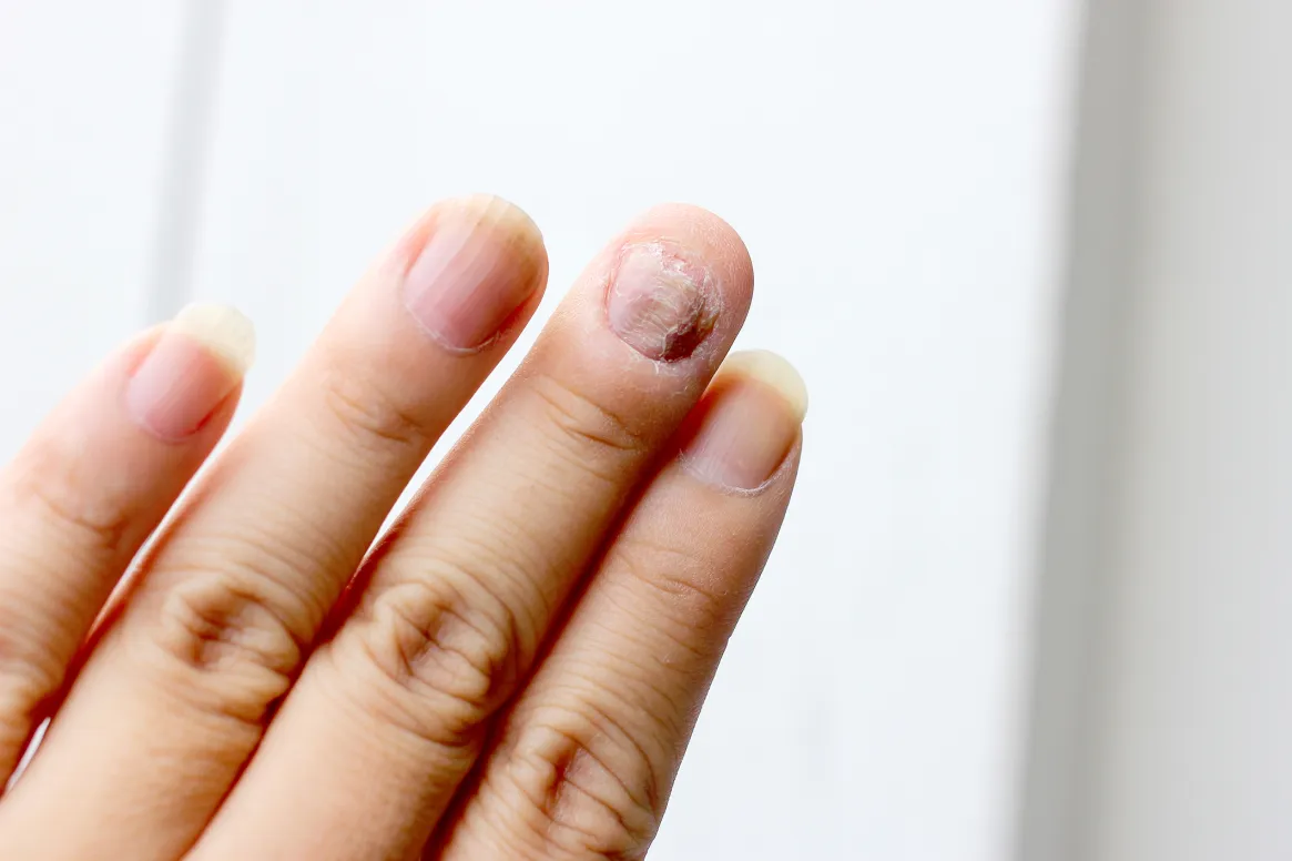 6 cách điều trị nấm móng tay tại nhà hiệu quả bạn cần biết