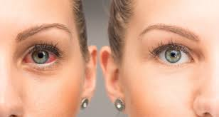 4 cách điều trị chữa đau mắt đỏ đúng cách và nhanh nhất