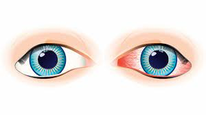 Làm thế nào để phân biệt đau mắt đỏ và lẹo mắt?