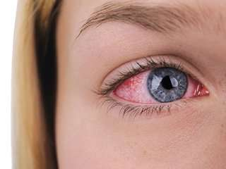 6 cách phòng tránh dịch đau mắt đỏ bạn cần biết