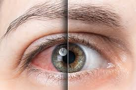 4 Mẹo chữa đau mắt đỏ nhanh nhất bạn cần biết