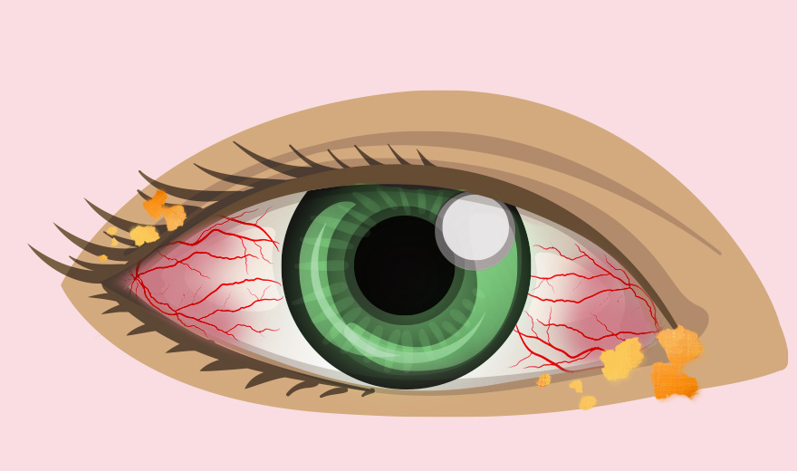 10 triệu chứng điển hình của đau mắt đỏ bạn cần biết