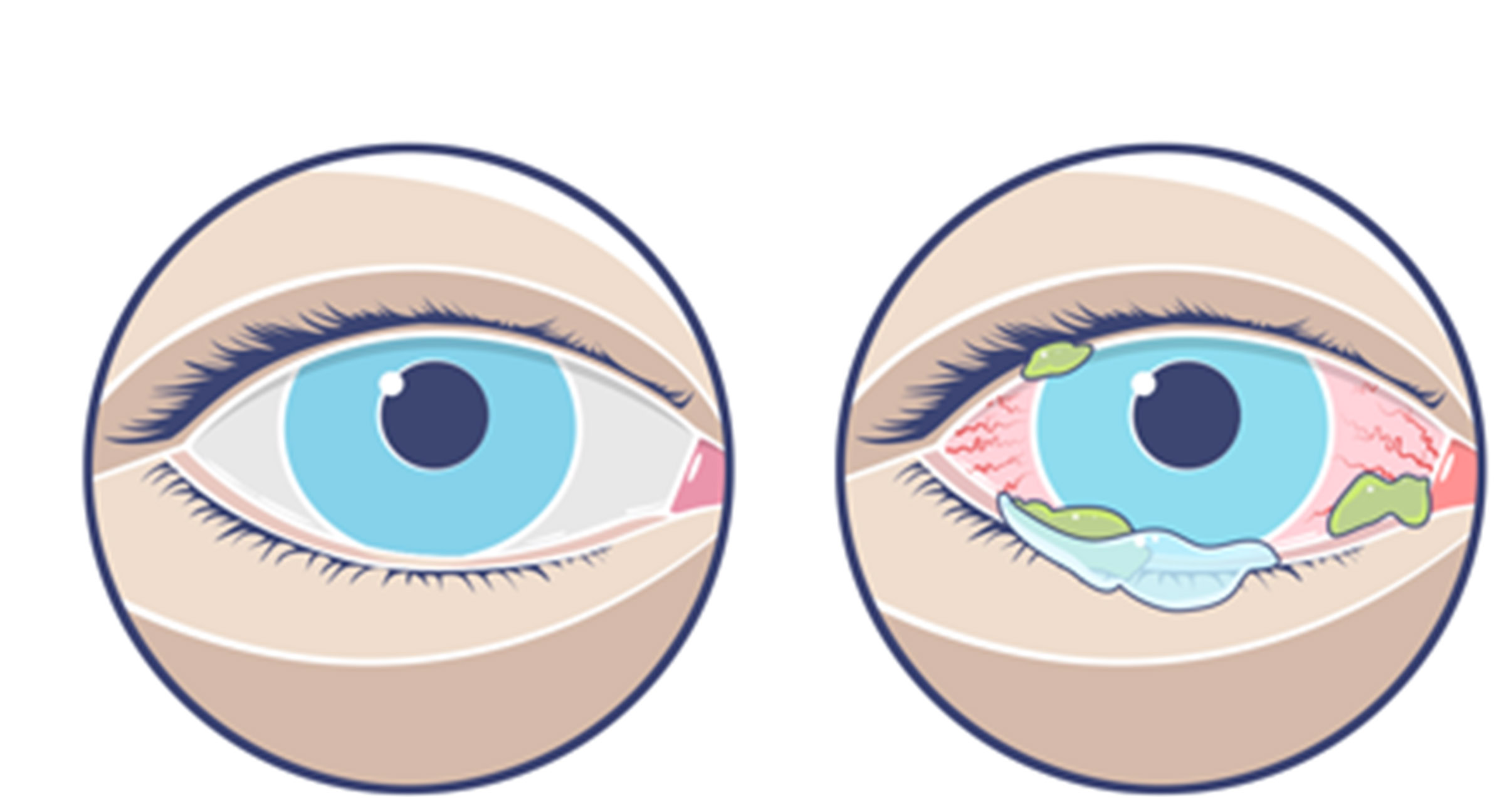 3 nguyên nhân chính gây đau mắt đỏ bạn cần biết