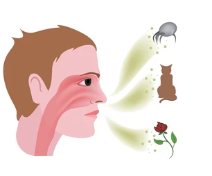 6 Cách điều trị viêm mũi dị ứng hiệu quả bạn cần biết