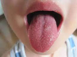 VIêm họng hạt ở lưỡi là bệnh gì? nguyên nhân, triệu chứng, cách điều trị và phòng ngừa
